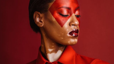 overGirl’s model with vitiligo