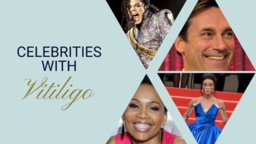 celebrities with vitiligo