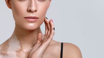 vitiligo skin care