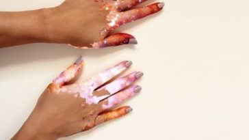 vitiligo art