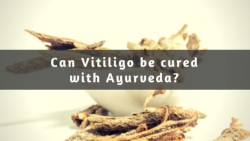 Ayurveda for Vitiligo