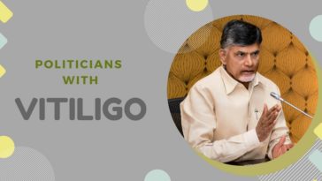 Politicians who have Vitiligo