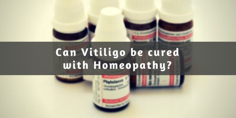 homeopathy treatment for vitiligo