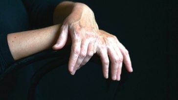 vitiligo and depression