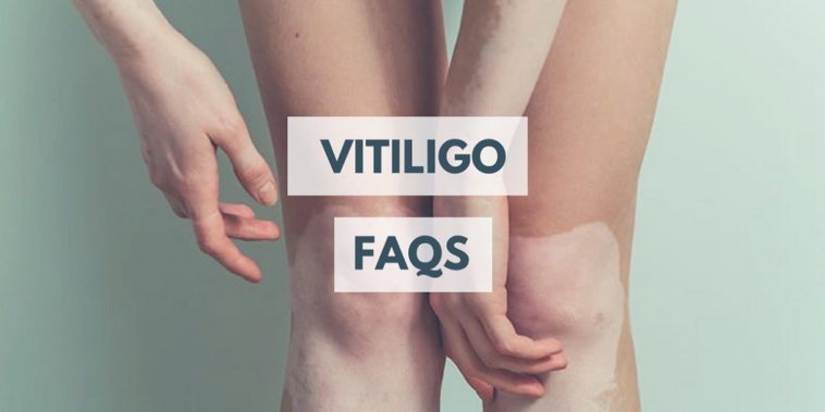 vitiligo FAQs