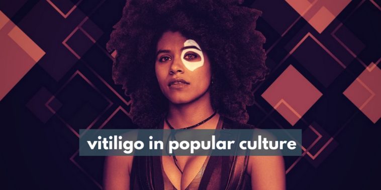 vitiligo in popular culture