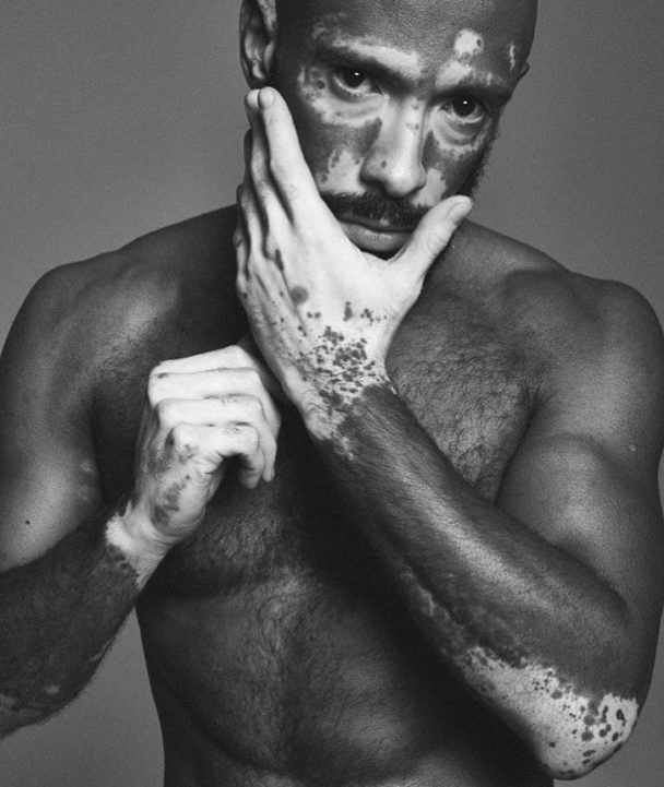 10 Most Attractive Vitiligans (2018) Men Unite For Vitiligo