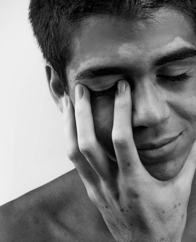 Vitiligo essay picture