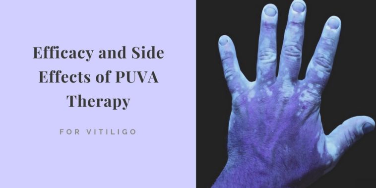 PUVA Therapy for Vitiligo