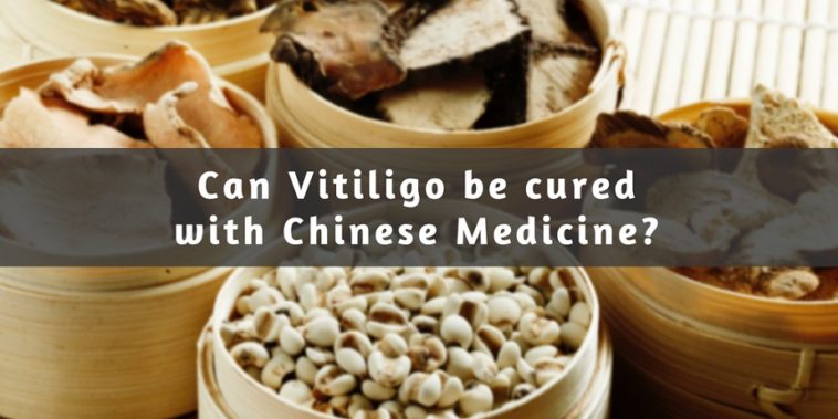 chinese medicine for vitiligo