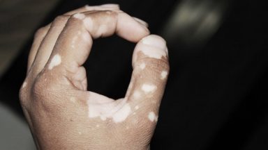Losing Color 7 Stages of Coming to Terms with Vitiligo – Unite For Vitiligo
