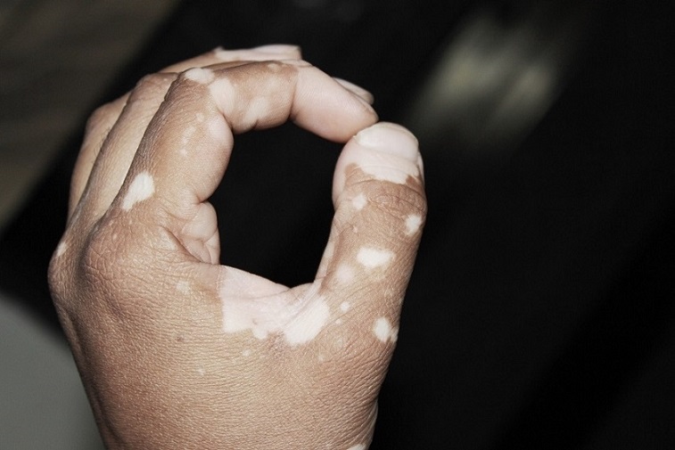 self-acceptance in vitiligo
