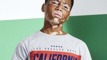 primark vitiligo
