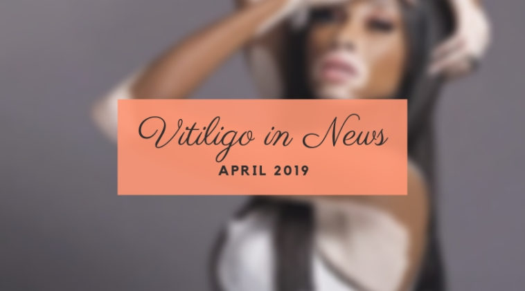 Vitiligo in April 2109