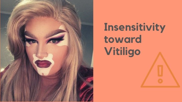 Vitiligo’s Representation in The White Tiger – Questions That Matter ...