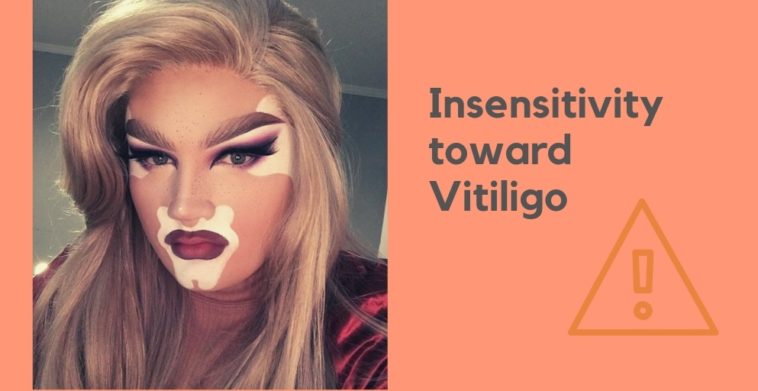 Insensitivity towards Vitiligo