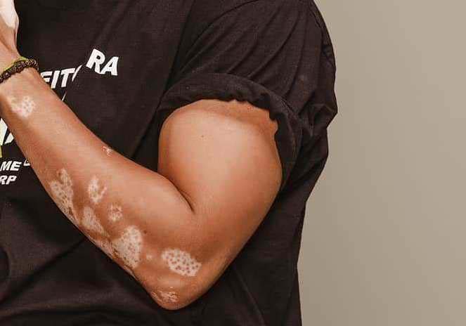confetti vitiligo