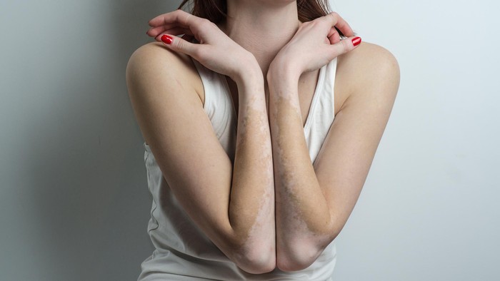 Oxidative stress and vitiligo