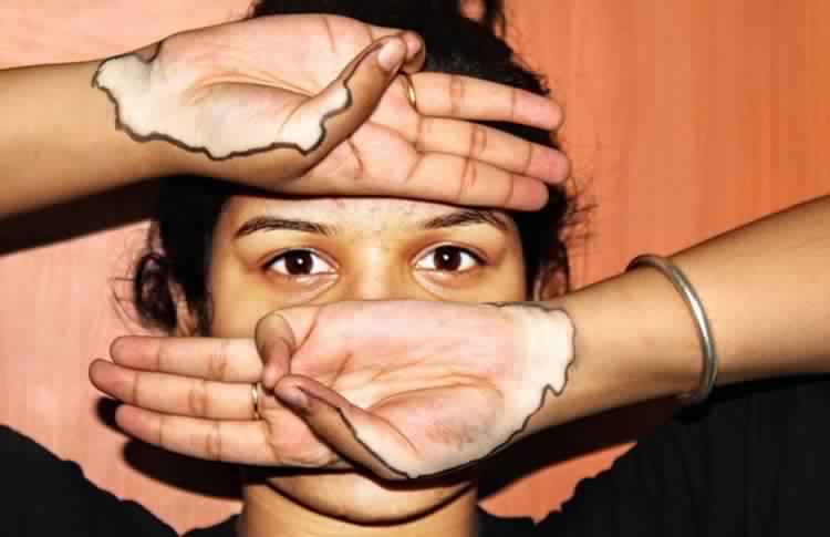 Kartiki Bhatnagar vitiligo