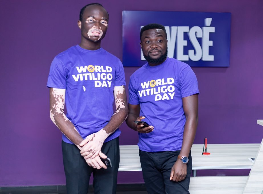 World Vitiligo Day in Ghana
