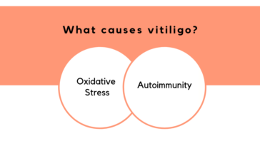 what causes vitiligo