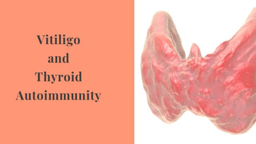 Vitiligo and Thyroid
