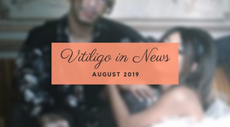 Vitiligo in News