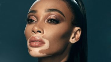 Winnie Harlow