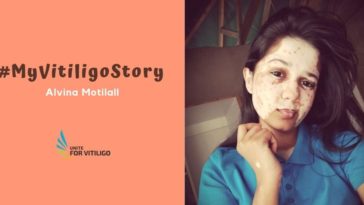 Alvina Motilall's vitiligo story