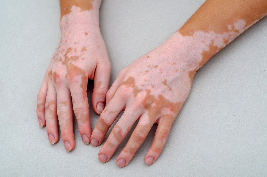 Tissue grafting surgeries for vitiligo