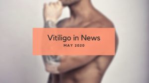 Vitiligo News May 2020