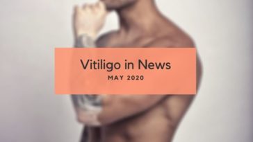 Vitiligo News May 2020