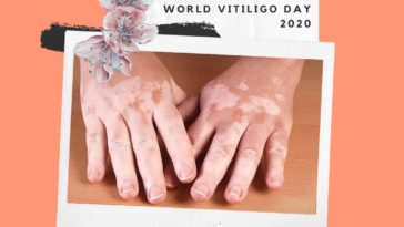 world vitiligo day 2020