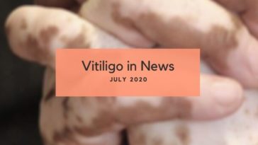 Vitiligo News July 2020