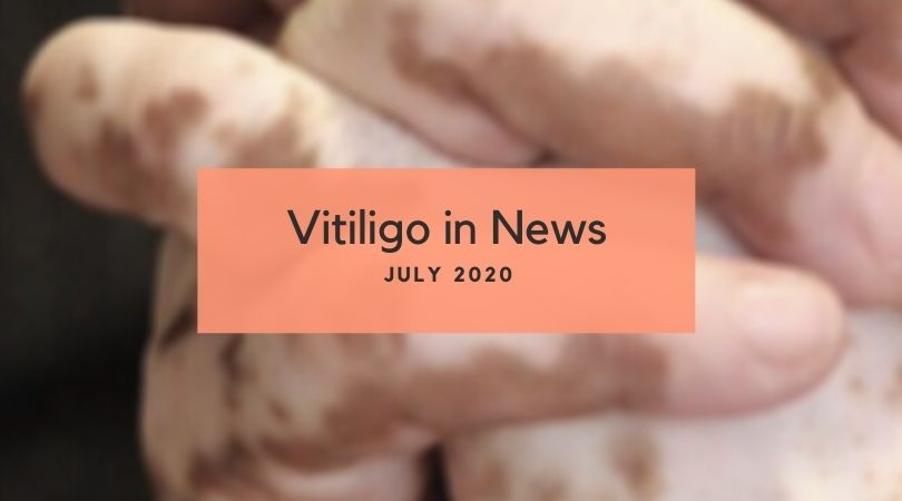 Vitiligo in News July 2020 Unite For Vitiligo