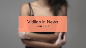 Vitiligo News June 2020