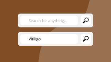 search on vitiligo