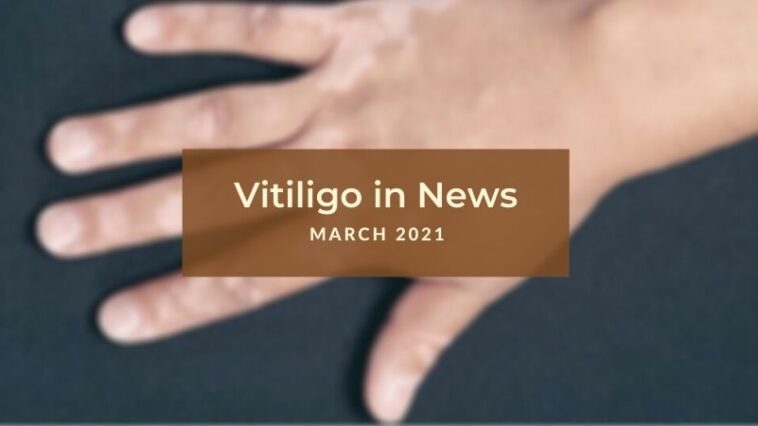 6 Differences Between Vitiligo And Leucoderma Unite For Vitiligo 6 Differences Between Vitiligo And Leucoderma Unite For Vitiligo
