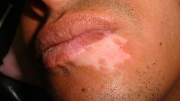 Focal vitiligo
