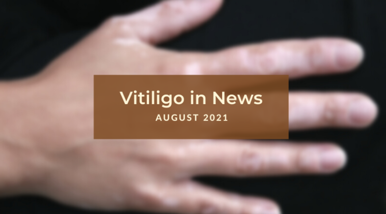 Vitiligo News - August 2021