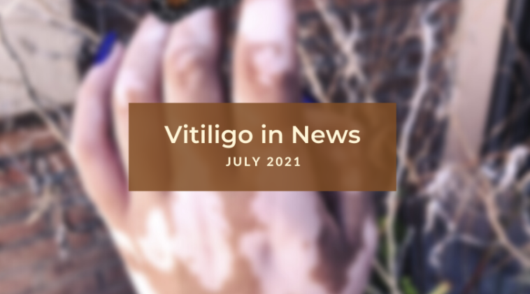 Vitiligo News July 2021