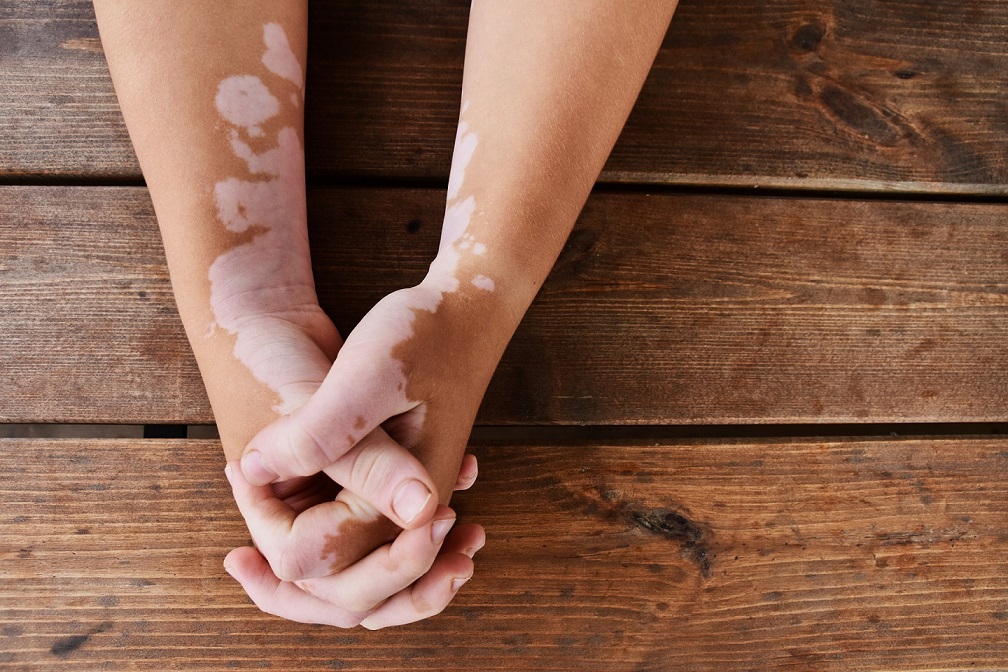 Ginkgo Biloba for Vitiligo