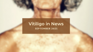 Vitiligo News - September 2021