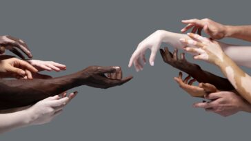 vitiligo hands