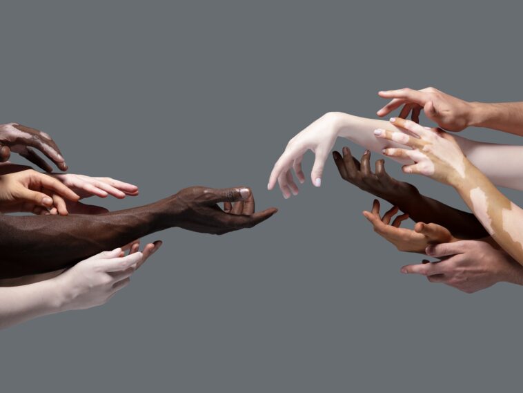 vitiligo hands