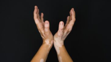 Vitiligo on Hands