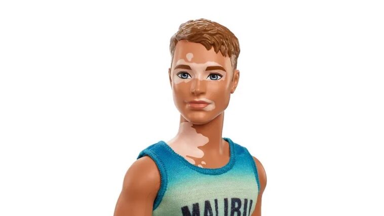 Ken doll with vitiligo – Unite For Vitiligo