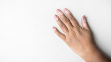 Post-Traumatic Stress in vitiligo