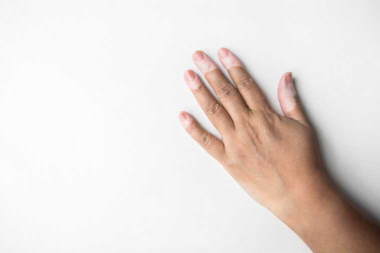 Post-Traumatic Stress in vitiligo