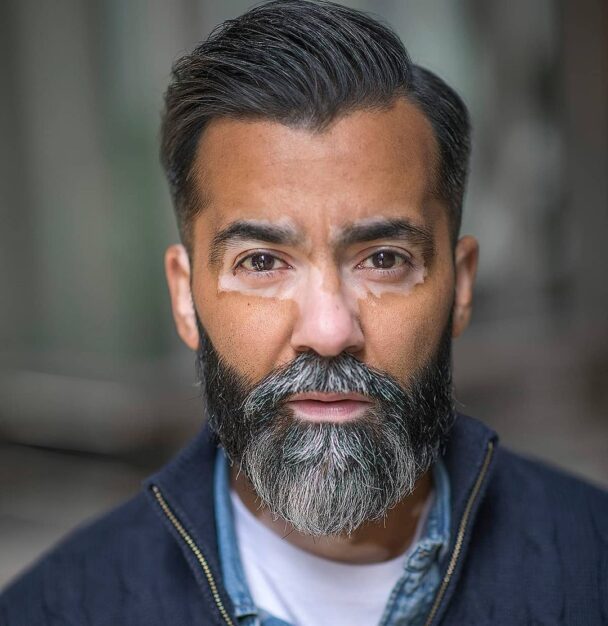 Vitiligo and Copper Deficiency What’s the connection? Unite For